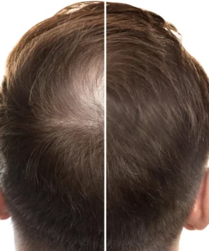 Ancient Chinese medicine could transform hair loss treatment